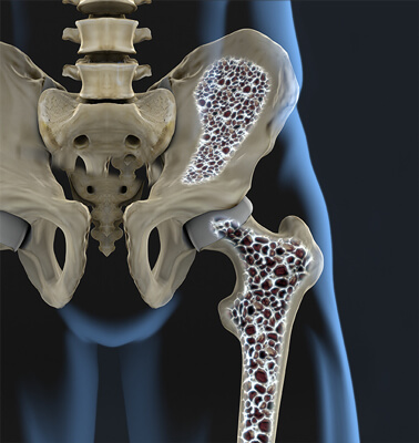osteoporotic bones 1